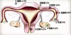 泰国试管婴儿也会引起宫外孕是真的吗?