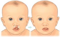 泰国第三代试管婴儿能都筛选唇腭裂吗?